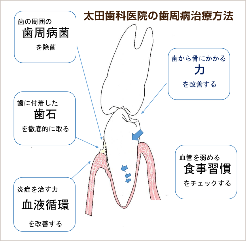 太田歯科医院の歯周病治療方法
