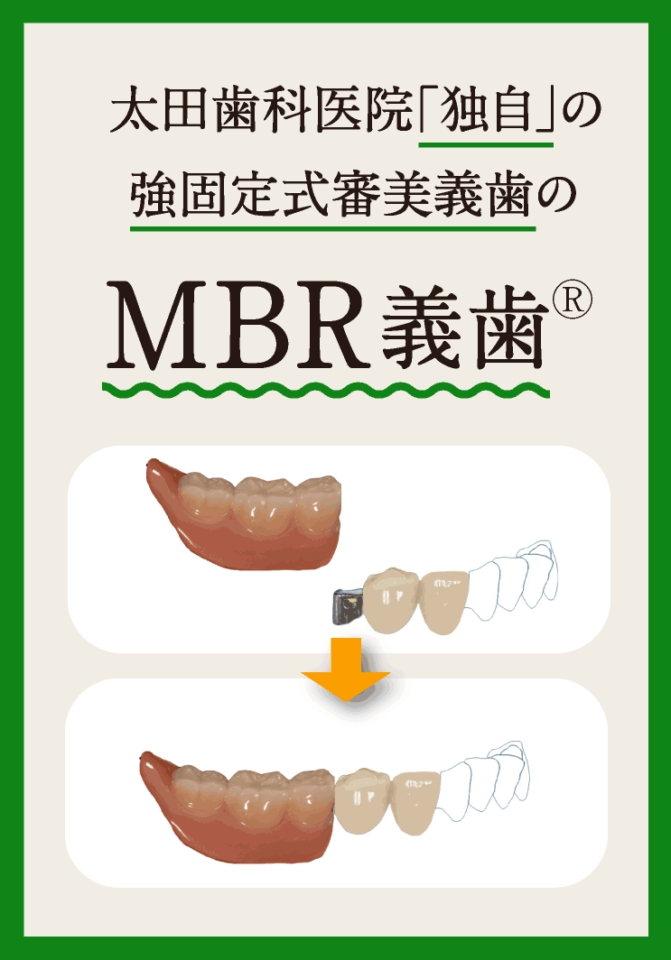 MBR義歯